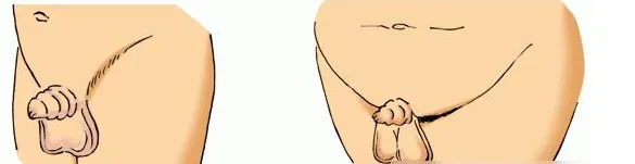 隐匿性阴茎是指阴茎体外观不显著,几乎完全藏于耻骨前软组织内,但实际